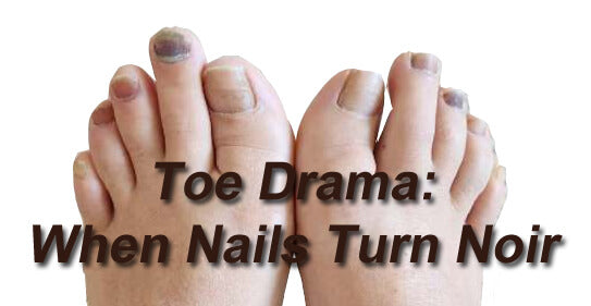 Toe Drama: When nails turn noir